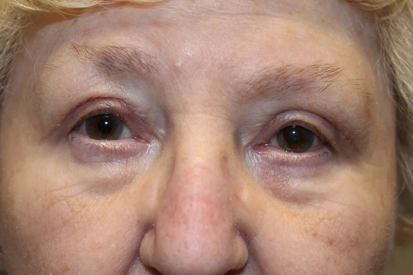 After Upper Blepharoplasty · Ptosis Repair — patient photo
