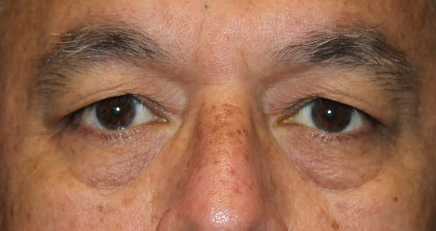 Before Upper Blepharoplasty — patient photo