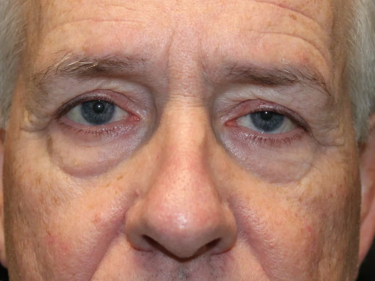 Before Lower Blepharoplasty · Left Ptosis Repair — patient photo