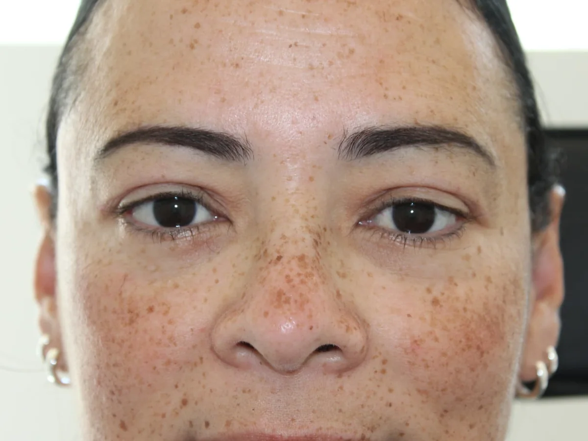 After Upper Blepharoplasty — patient photo