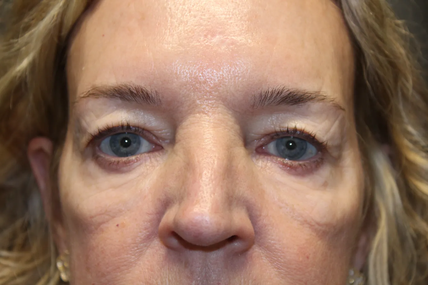 Before Upper Blepharoplasty · Doxycycline Injection to Lower Eyelid Festoons — patient photo